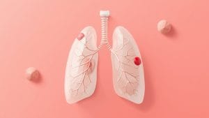 Inhaled Drug Shows Promise for Rare Lung Condition in Major Clinical Trial